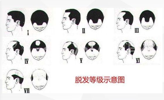 脱发有人治好吗,脱发治好了还能长出新发吗