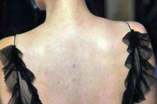 断货王祛痘胶囊,秒杀祛痘化妆品一元