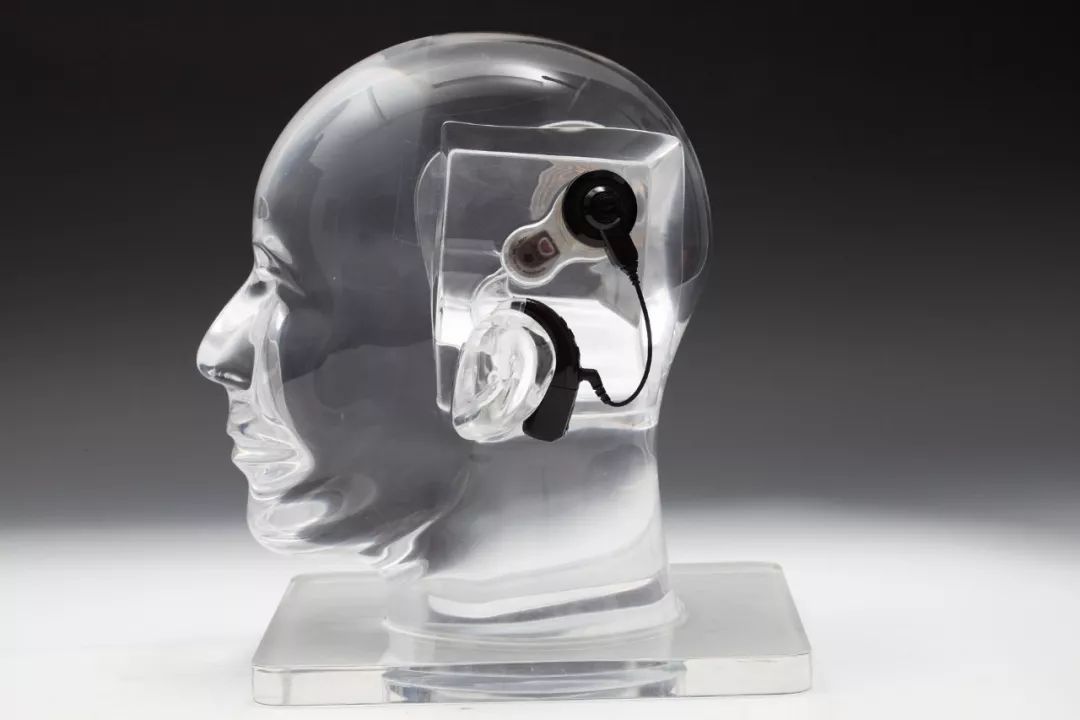 诺尔康人工耳蜗怎么充电视频教程,诺尔康人工耳蜗abcd模式