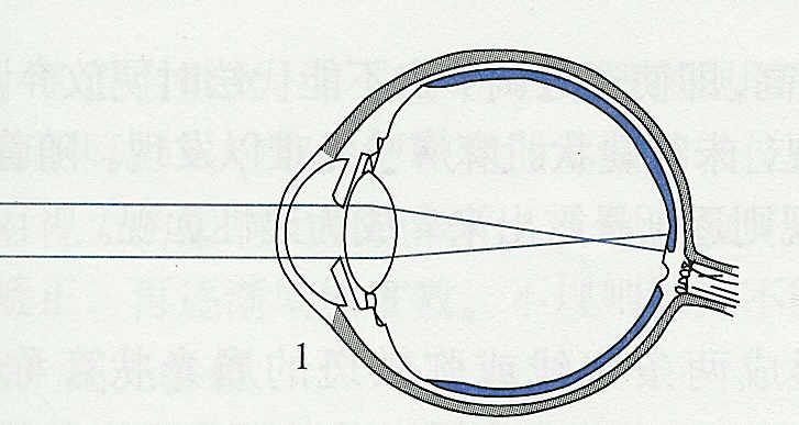 医生说孩子眼球不正常,医生诊断屈光不正是什么意思