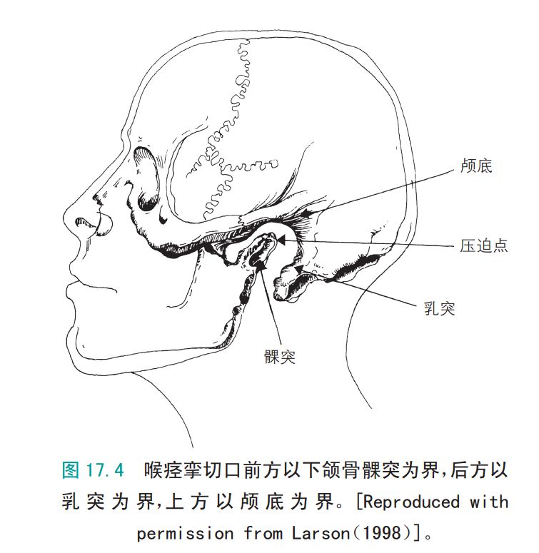 气管插管患者拔管程序,气管插管拔管原因分析及整改措施