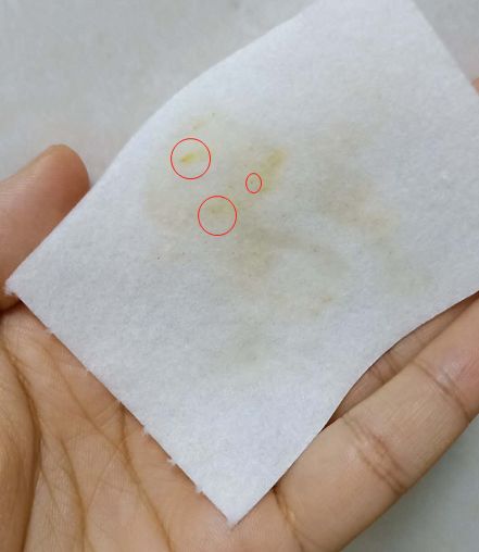 拒绝草莓鼻夹子夹出粉刺,拒绝草莓鼻毛孔粗大