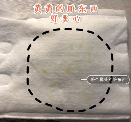 拒绝草莓鼻夹子夹出粉刺,拒绝草莓鼻毛孔粗大