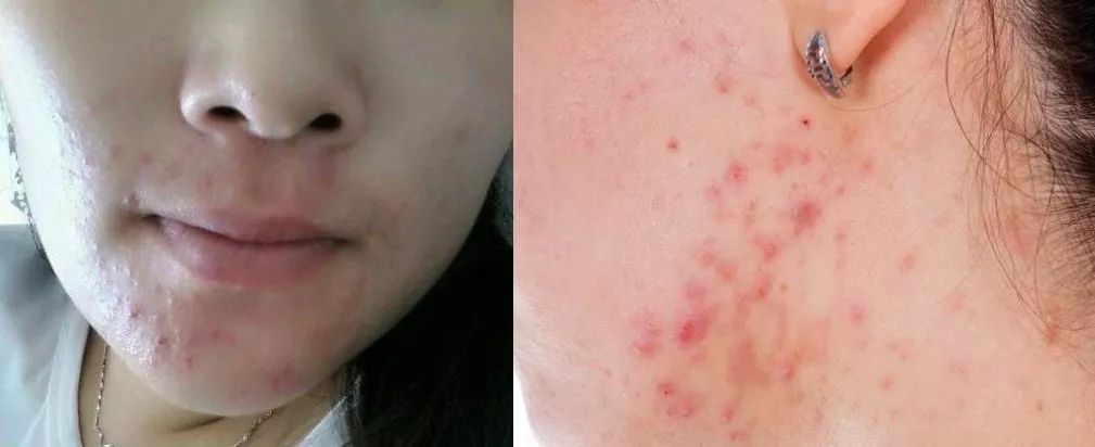 日本除螨喷雾杀螨虫,去螨虫神器和一般紫外线除螨仪