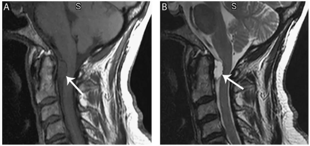 多图多表：带你识别颅内囊肿的影像学表现丨实战读片