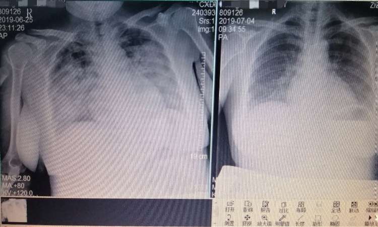 怀孕得了登革热怎么办,新冠高烧39孕妇有事吗