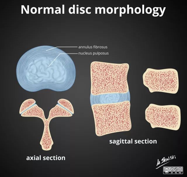 椎间盘膨出脱出图解,椎间盘膨出脱出和突出哪个更严重