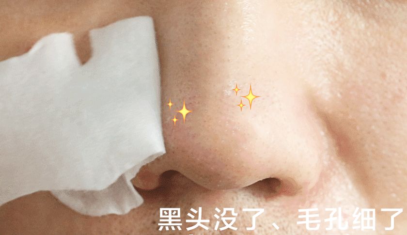 如何摆脱黑头反复的困扰才最有效,用黑头仪吸完黑头黑头还会再长吗