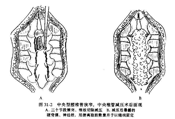 一分钟带你了解腰椎狭窄,椎管狭窄症知识大全