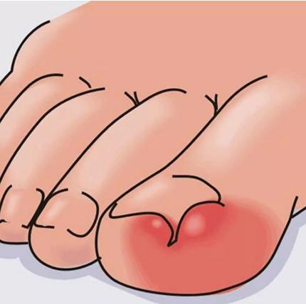 脚指甲增厚长进肉里最佳治疗方法,指甲根部嵌甲太深拔不出来怎么办