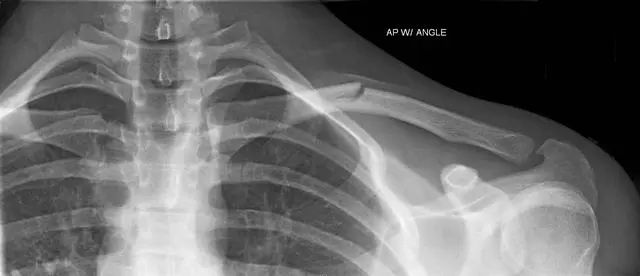 新生小孩锁骨骨折怎么办？