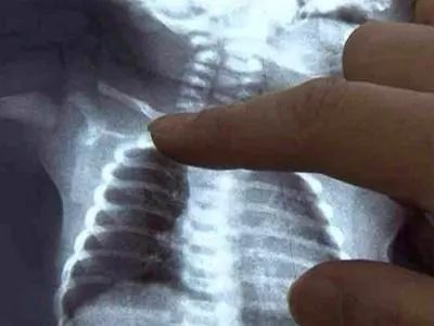 新生小孩锁骨骨折怎么办？