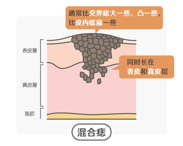 突然长痣是不是出了什么问题知乎,女人左手背突然长痣代表什么