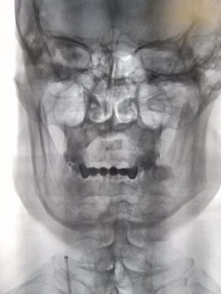 颈内动脉闭塞先进治疗,颈内动脉闭塞开通术病例讨论