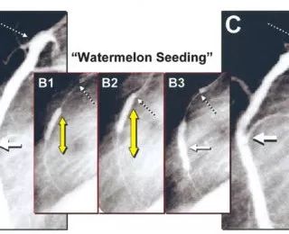 支架内再狭窄可能的机制,支架内再狭窄的临床处理措施有