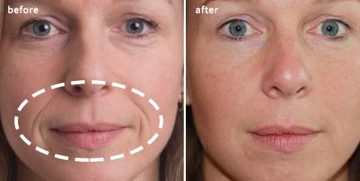 眼膜贴八小时紧致抗皱淡细纹,官方眼膜紧致抗皱淡细纹法令纹