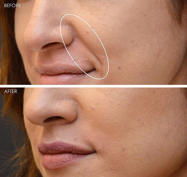 35岁了法令纹鱼尾纹眉间纹怎么办,三十岁就有眉间纹法令纹怎么办