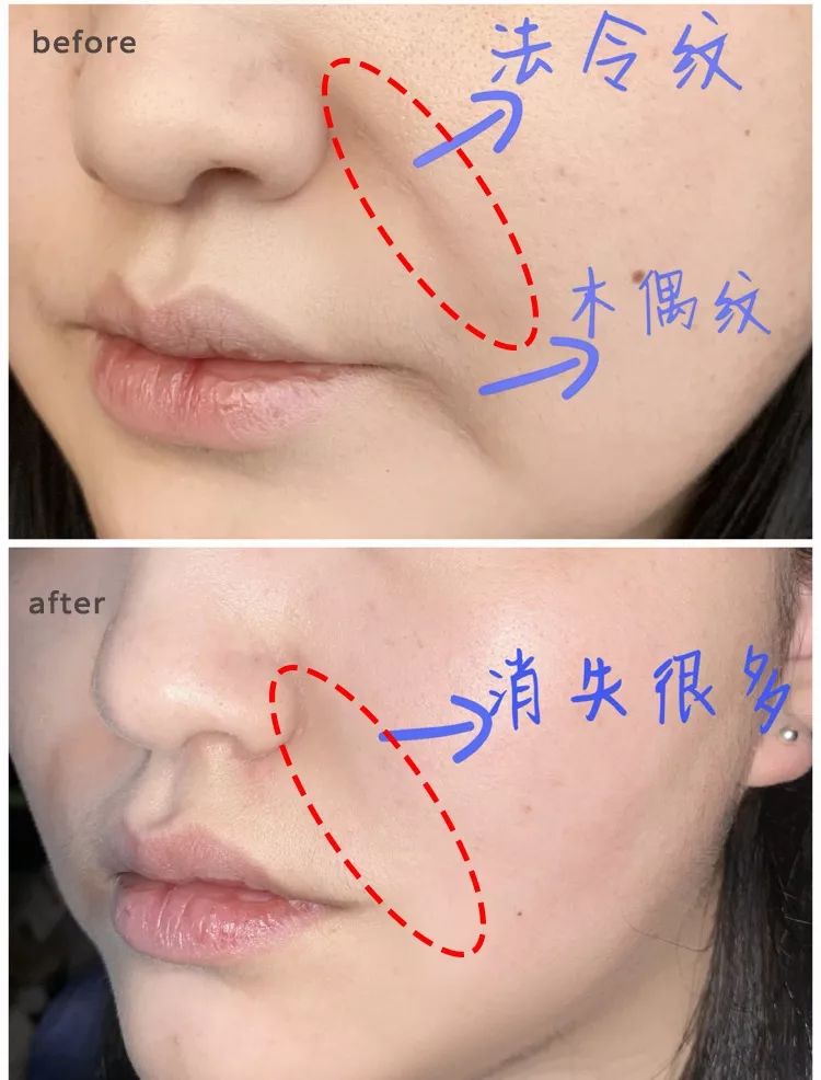 35岁了法令纹鱼尾纹眉间纹怎么办,三十岁就有眉间纹法令纹怎么办