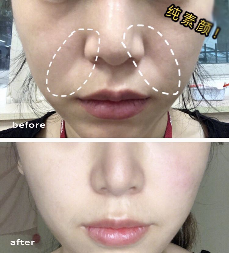 三十岁就有眉间纹法令纹怎么办,30岁法令纹眉心纹深