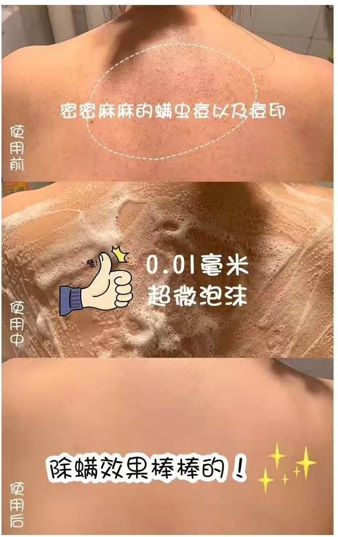 可美金箔祛痘螨虫皂,除螨皂能祛螨虫吗