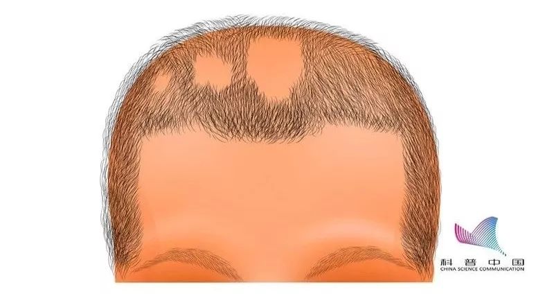 鬼剃头究竟是怎么回事,鬼剃头是谁发现的