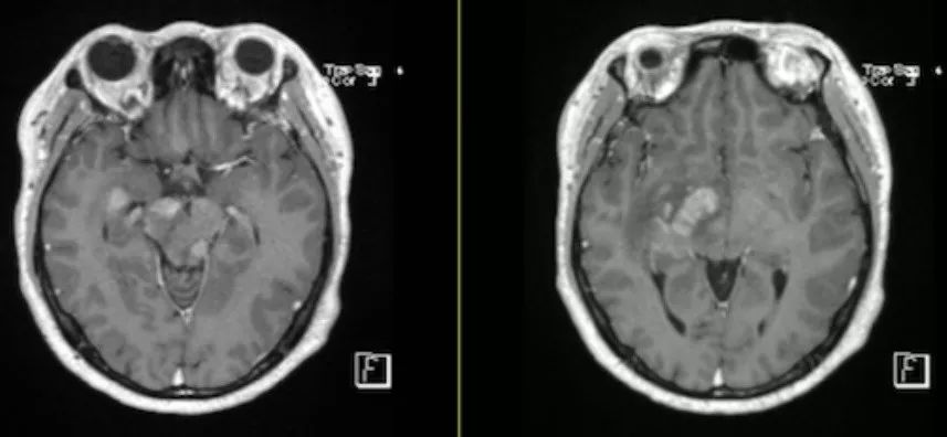急性脂肪栓塞、神经白塞病、NMOSD极后区综合征丨3分钟读片·第11期
