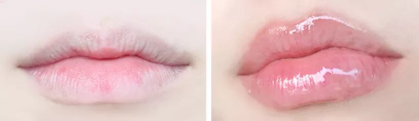 薄唇如何丰唇好看,丰唇使嘴唇变得更美