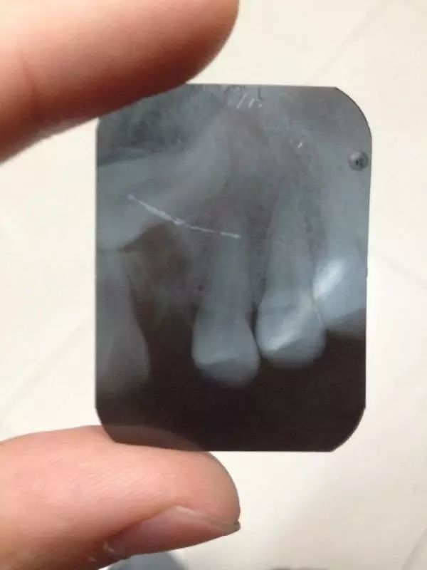 为什么出牙期会频繁发烧,出牙引起低烧持续多久