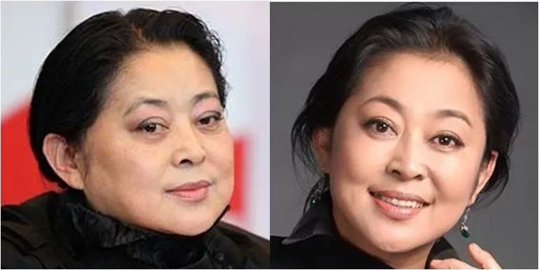 眼袋松弛下垂最快解决方法,严重眼袋下垂松弛怎么恢复