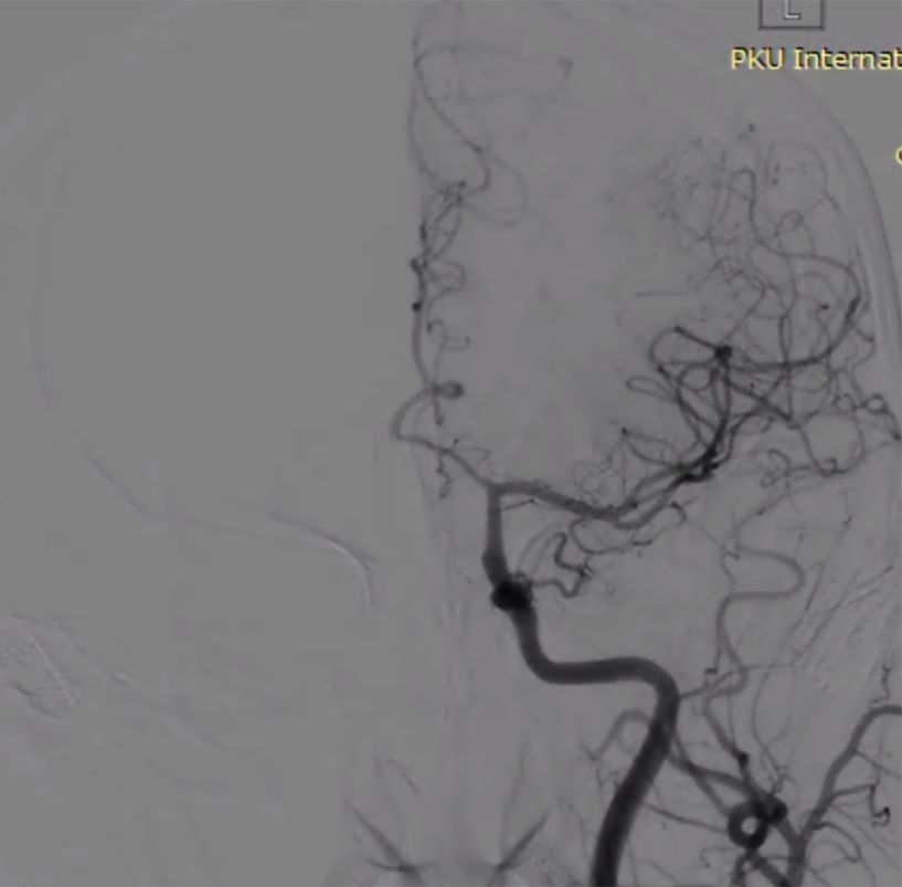 物华天宝·第7期｜脑部长型巨大夹层动脉瘤的4个密网支架桥接治疗复查治愈（附复查CTA结果）