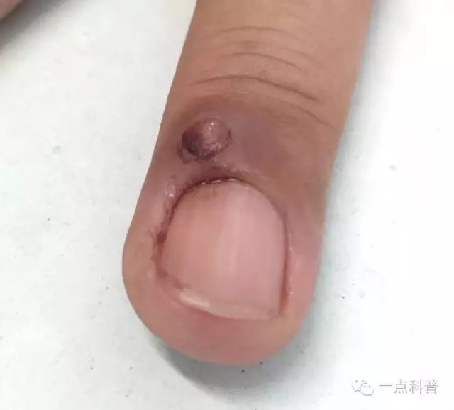 不要再撕嘴唇死皮了,很可能撕出这种病,会血流不止...