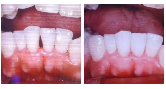 为什么下门牙突,特别爱长牙石是怎么回事