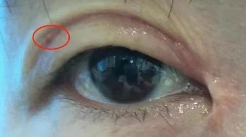 女子整形割双眼皮,女子整容后惨不忍睹