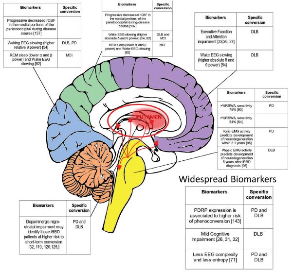快速眼动期睡眠行为障碍中医治疗,快速眼动睡眠障碍症能活多久