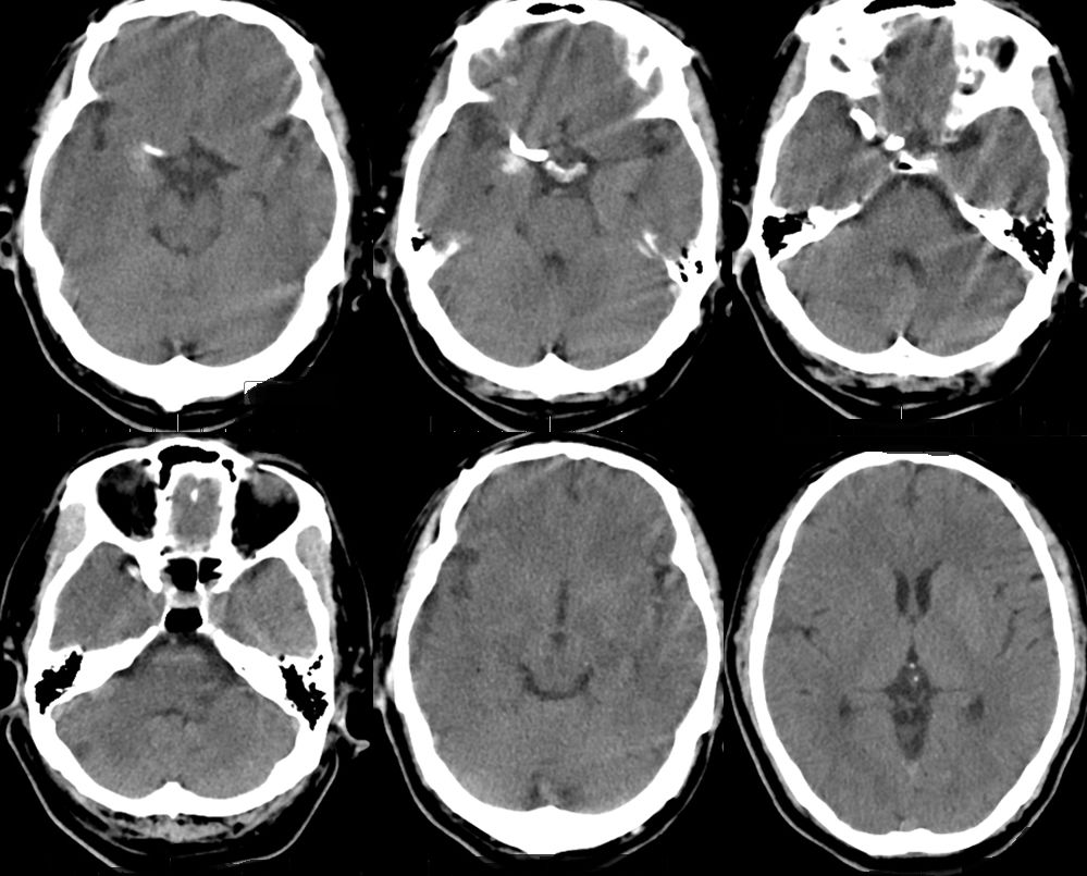 治疗颅内动脉瘤新型密网支架,密网支架处理动脉瘤的风险