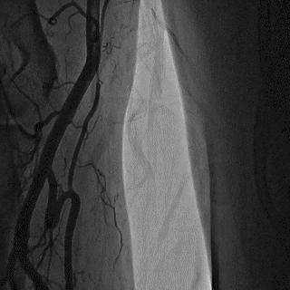 冠脉造影技术成熟不,跟我学技术分析从入门到精通