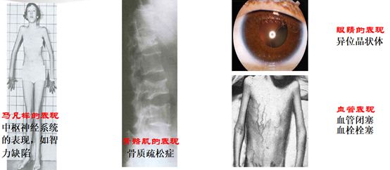 同型半胱氨酸健康科普涨知识,同型半胱氨酸怎样判断超标