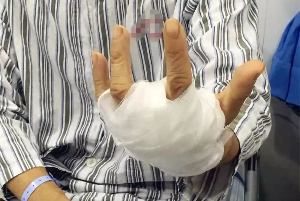 海鲜扎手容易感染什么弧菌,海鲜扎手死亡原因