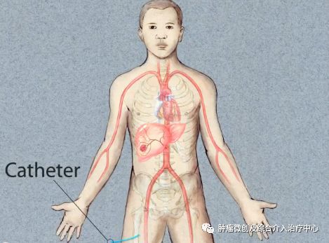 运城市第一医院介入科特色技术——肿瘤的化疗栓塞术
