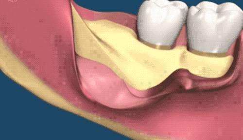 拔智齿的全过程科普,拔智齿细致操作过程