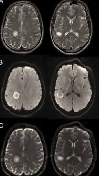 Whipple病、纹状体手、神经结节病、脱髓鞘假瘤丨3分钟读片·第16期