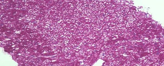 肝功能异常病例,肝功能异常10大病因