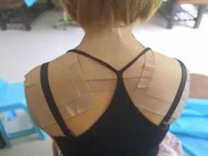 富贵包导致脖子筋痛用什么治疗,富贵包消除的最佳神器