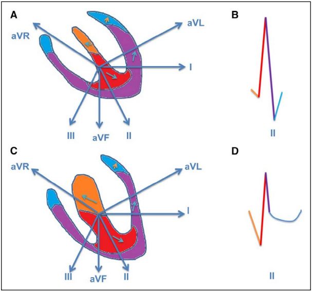 异常q波心电图怎么看图解,异常q波心脏彩超有什么表现