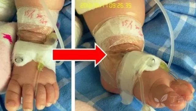 留置针u型敷贴正确撕法,留置针正确固定图片ppt