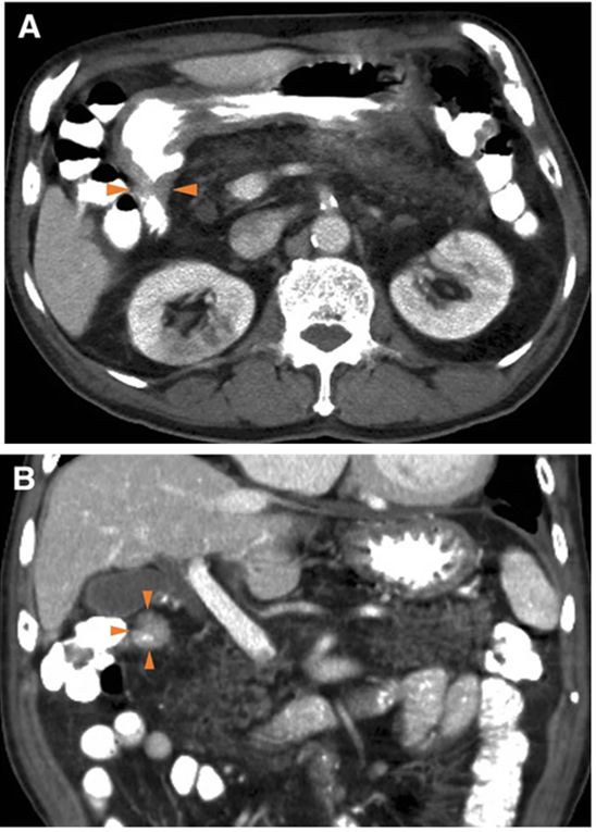 十二指肠腺癌2.5厘米几期,十二指肠癌罕见