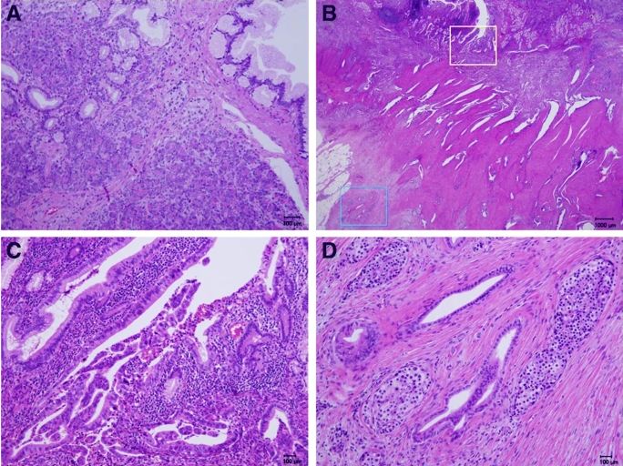 十二指肠腺癌累及胰腺算转移吗,罕见异位嗜铬细胞瘤1例