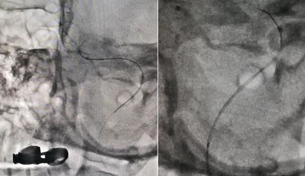 中医治疗脑夹层动脉瘤,3d演示夹层动脉瘤支架治疗