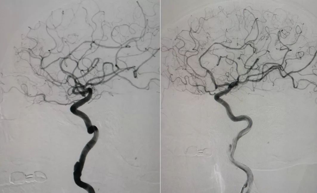 中医治疗脑夹层动脉瘤,3d演示夹层动脉瘤支架治疗