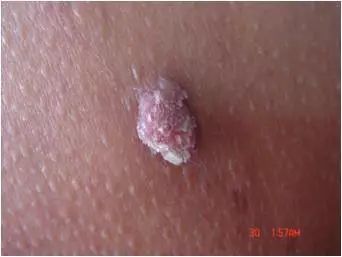 鸡眼和疣如何区别,掌跖疣是不是鸡眼